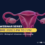 Webinaire – Imaging of endometriosis